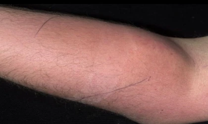 SIRT AĞRISINI HAFİFLETMEK İÇİN 18 AY BOYUNCA KENDİ SPERMİNİ KOLUNA ENJEKTE ETTİ.